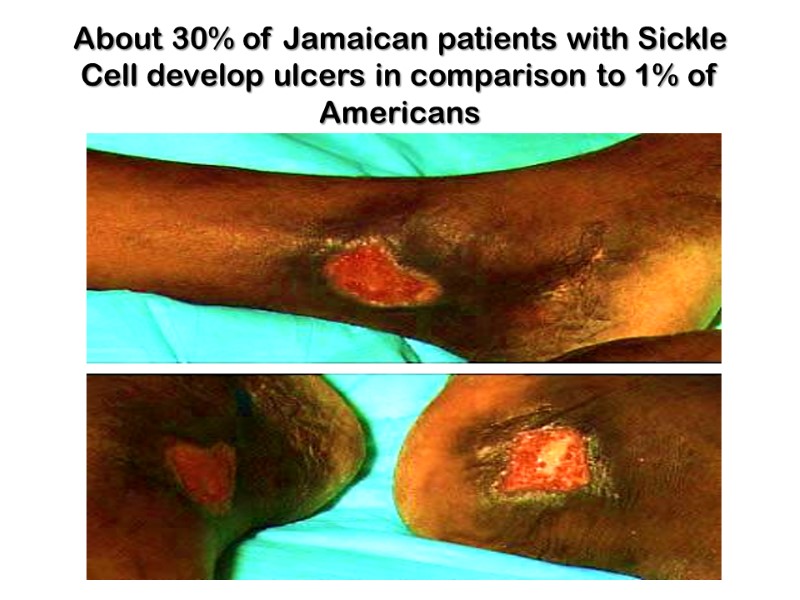 About 30% of Jamaican patients with Sickle Cell develop ulcers in comparison to 1%